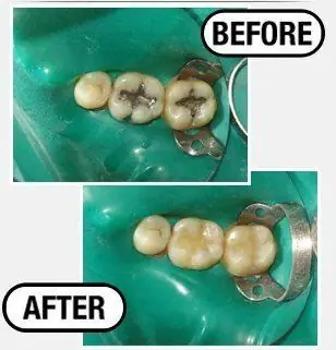 Before and after: a crown and filling replacement on molars