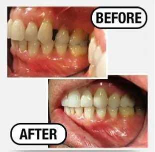 Before and after: a discolored, chipped front tooth restored to an even natural shade
