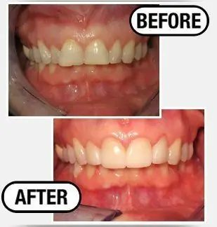 Before and after: upper front teeth restored, with an uneven gumline and shade corrected